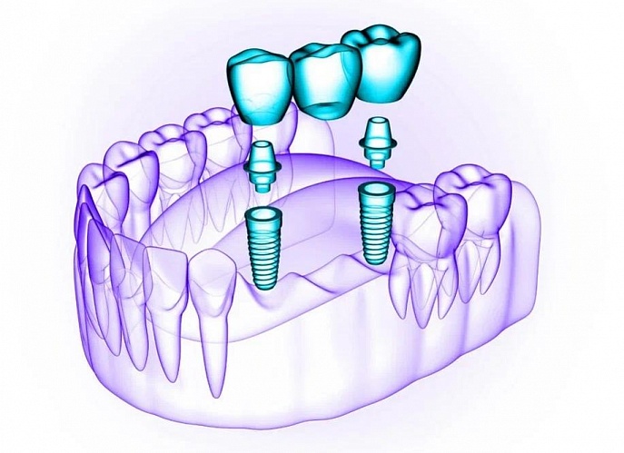  Стоматология в Новосибирске: имплантация зубов и цены на услуги